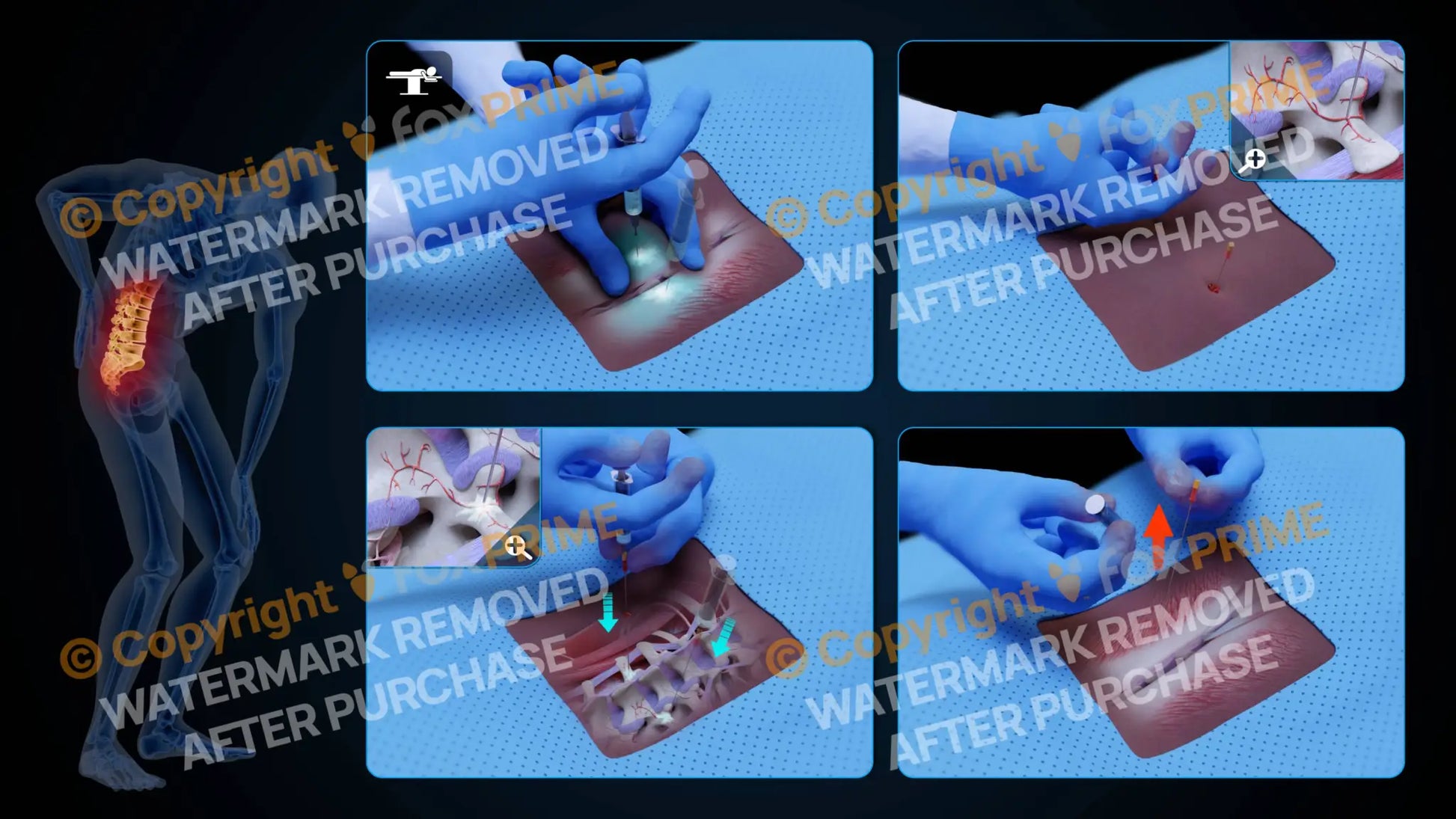 Bilateral Medial Branch Block L1-L2 (No Text) Still Shot