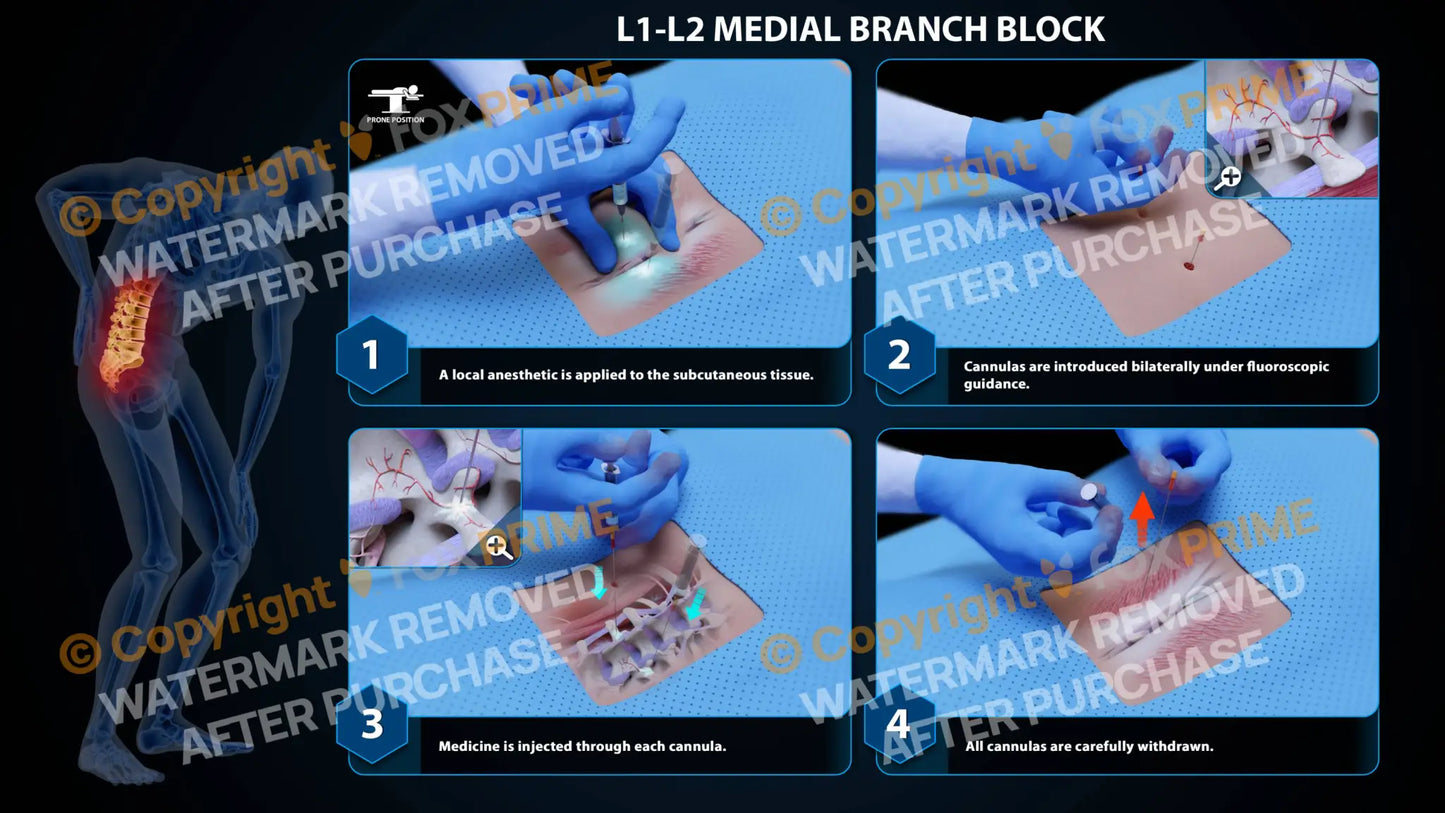Bilateral Medial Branch Block L1-L2 (PowerPoint) - PowerPoint
