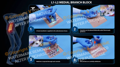 Bilateral Medial Branch Block L1-L2 - Still Shot