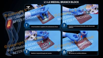 Bilateral Medial Branch Block L1-L2 Still Shot