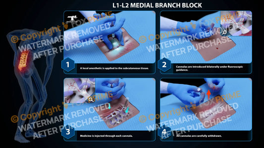 Bilateral Medial Branch Block L1-L2 - Still Shot
