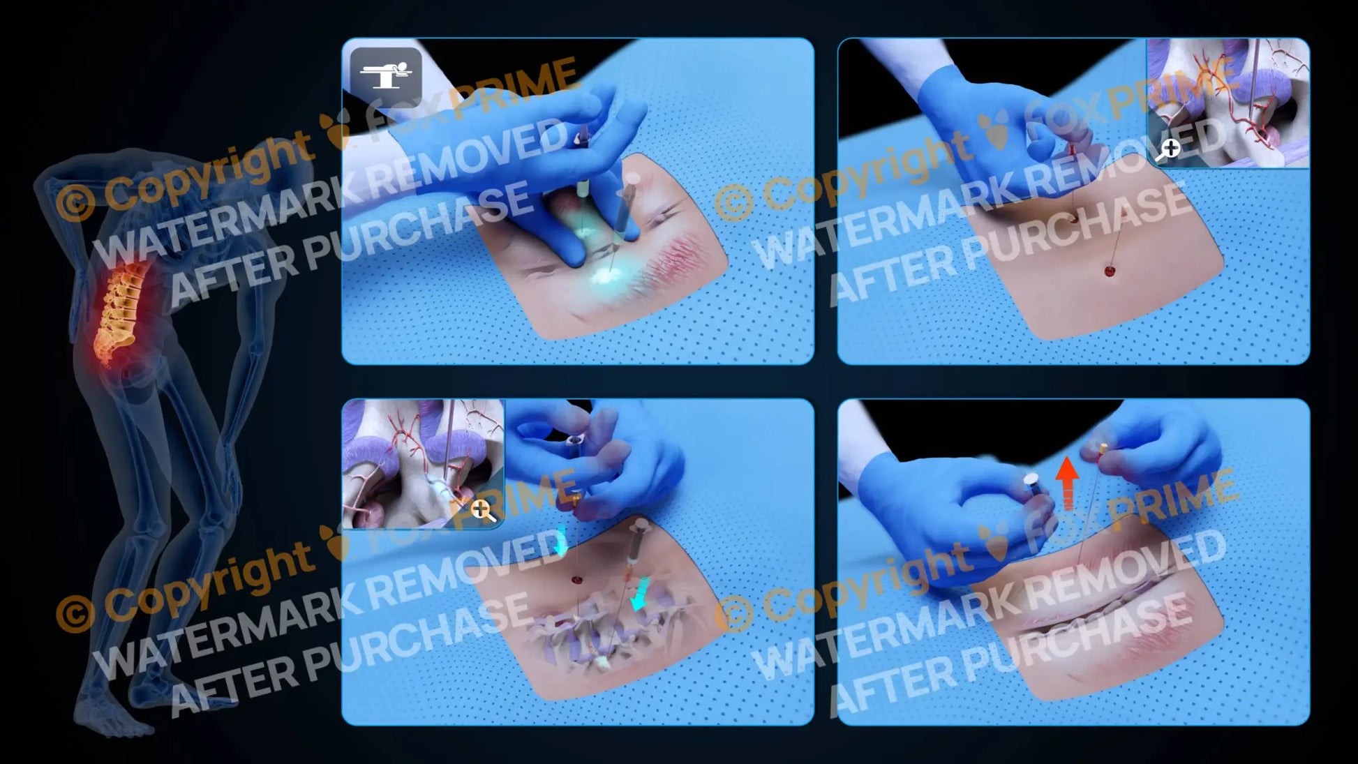 Bilateral Medial Branch Block L2-L3 (No Text) - Still Shot