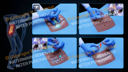 Bilateral Medial Branch Block L2-L3 (No Text) - Still Shot