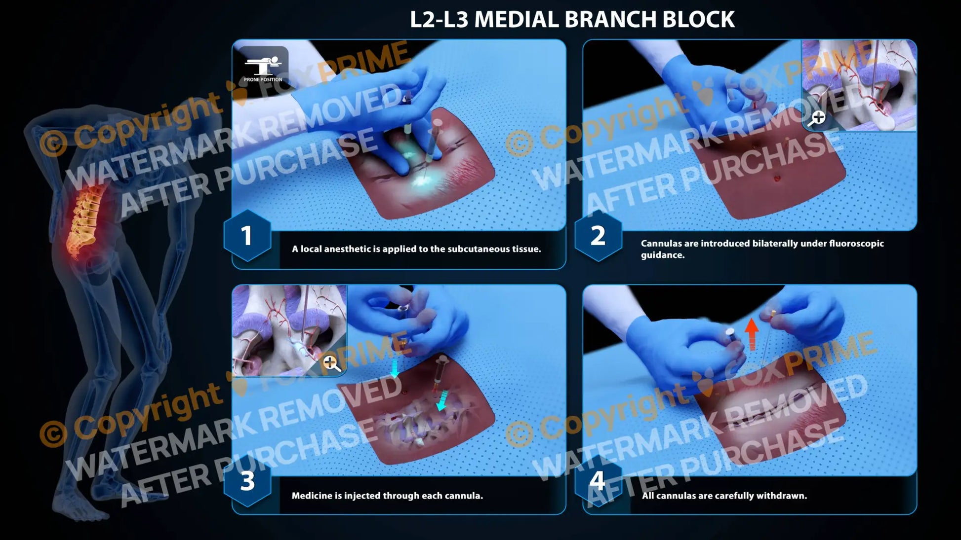 Bilateral Medial Branch Block L2-L3 Still Shot