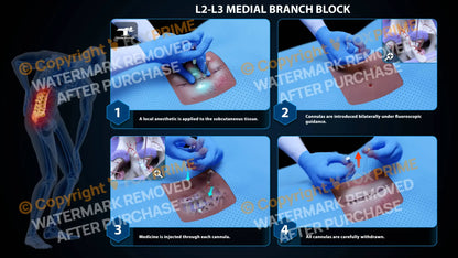 Bilateral Medial Branch Block L2-L3 Still Shot