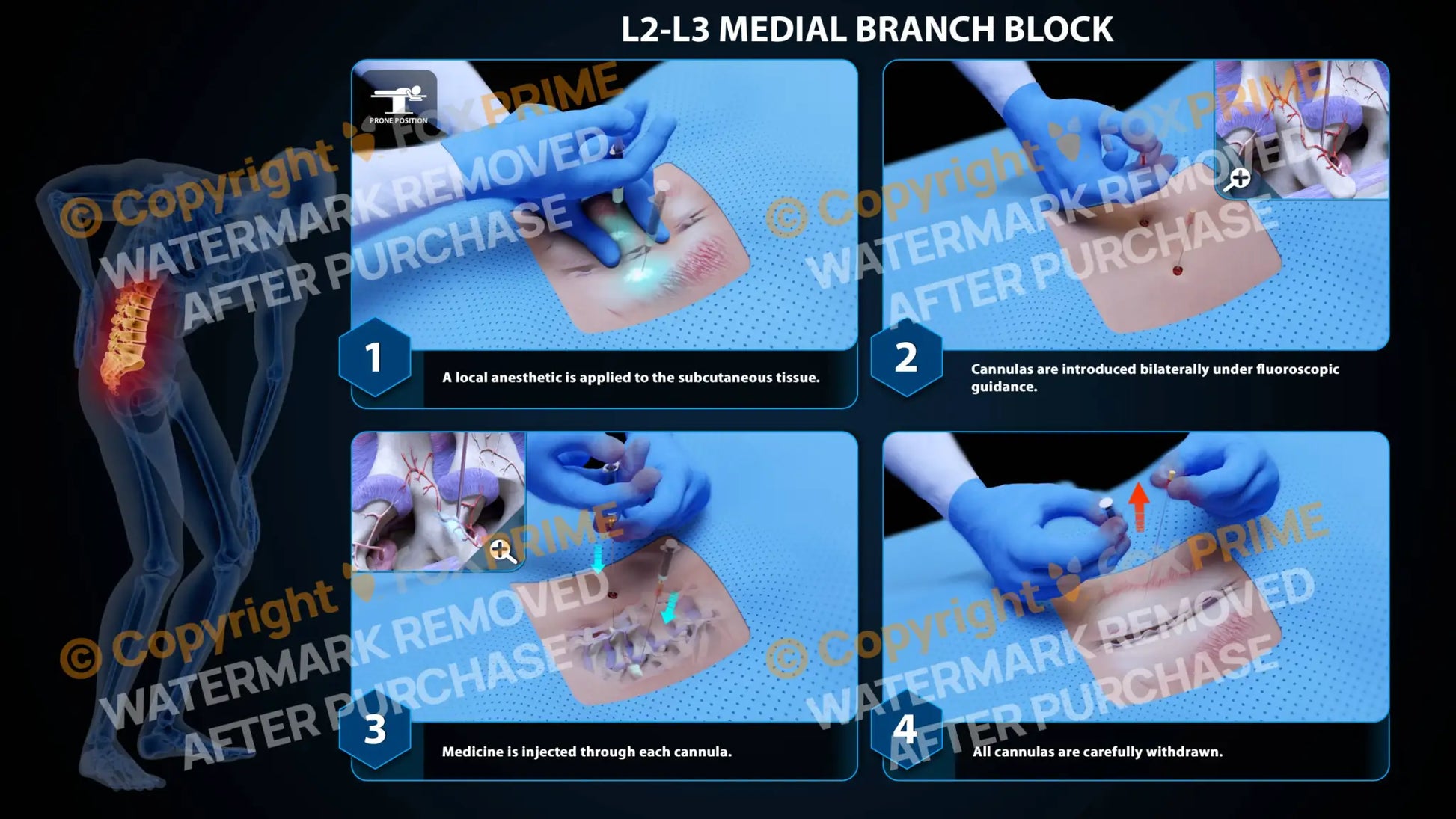 Bilateral Medial Branch Block L2-L3 - Still Shot