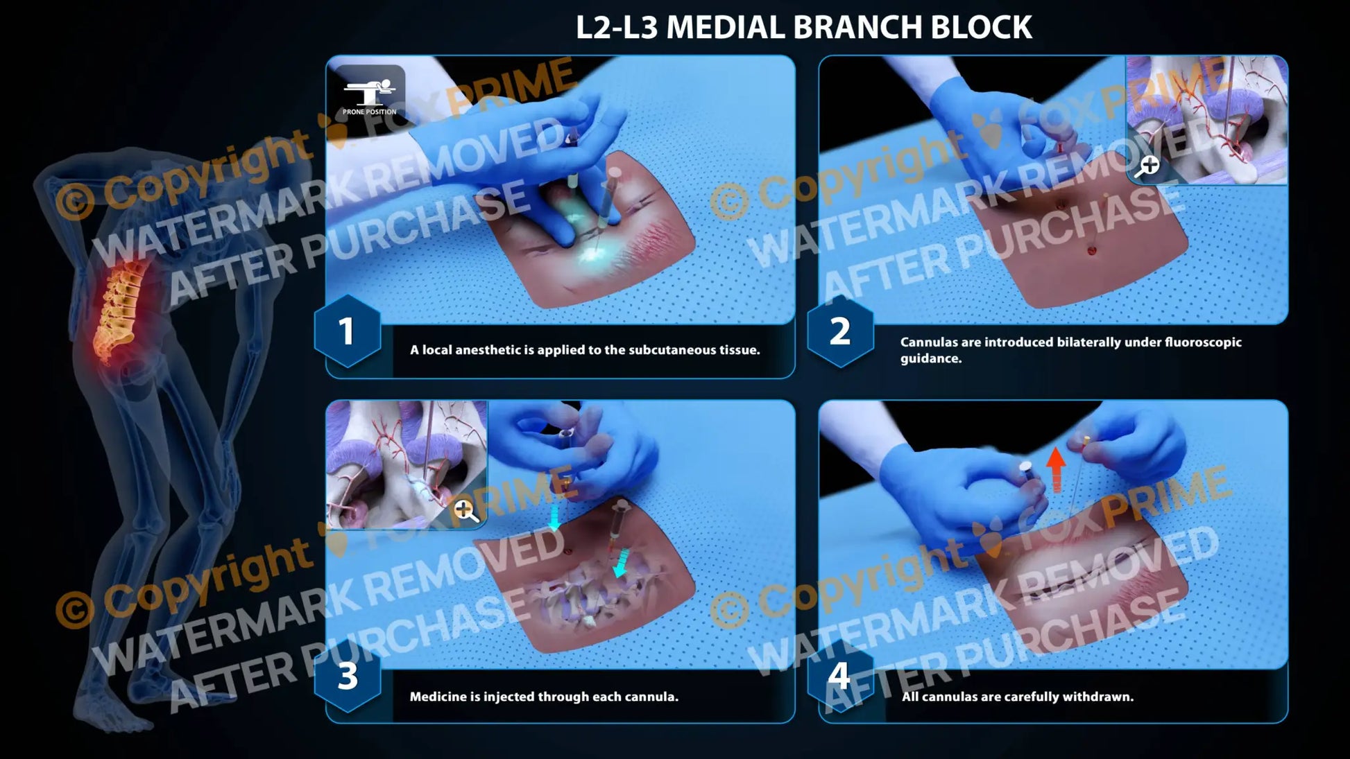 Bilateral Medial Branch Block L2-L3 - Still Shot