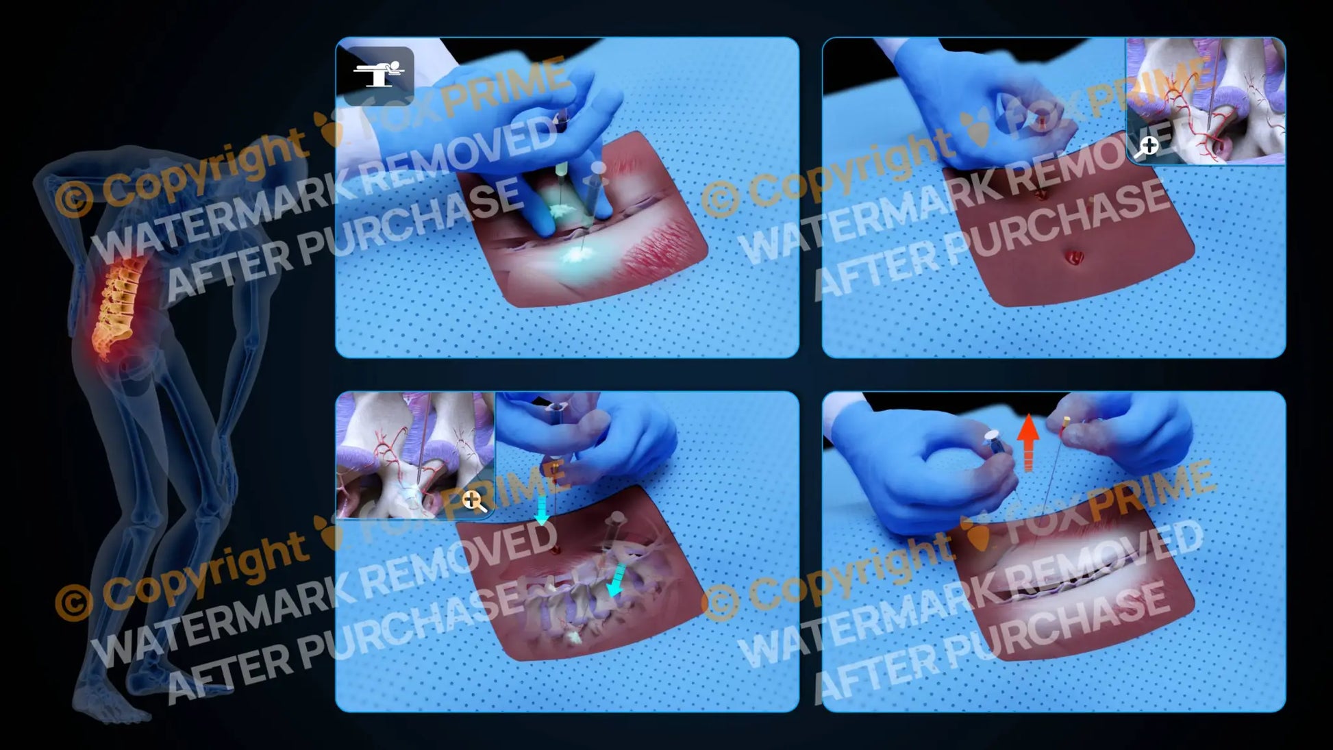 Bilateral Medial Branch Block L3-L4 (No Text) - Still Shot