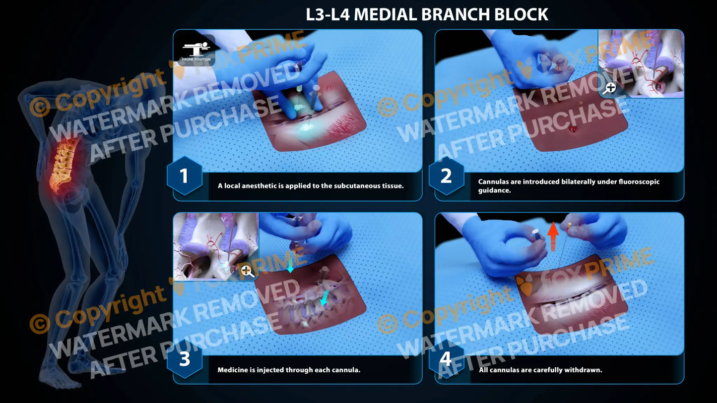 Bilateral Medial Branch Block L3-L4 (PowerPoint) - PowerPoint