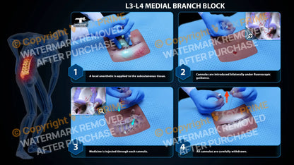Bilateral Medial Branch Block L3-L4 - Still Shot