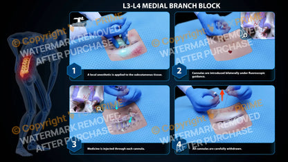 Bilateral Medial Branch Block L3-L4 - Still Shot