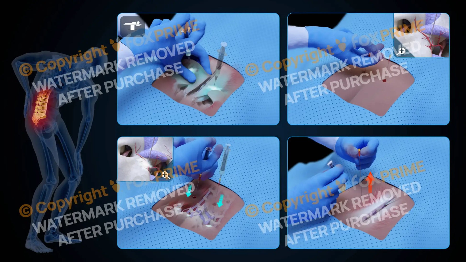 Bilateral Medial Branch Block L4-L5 (No Text) - Still Shot