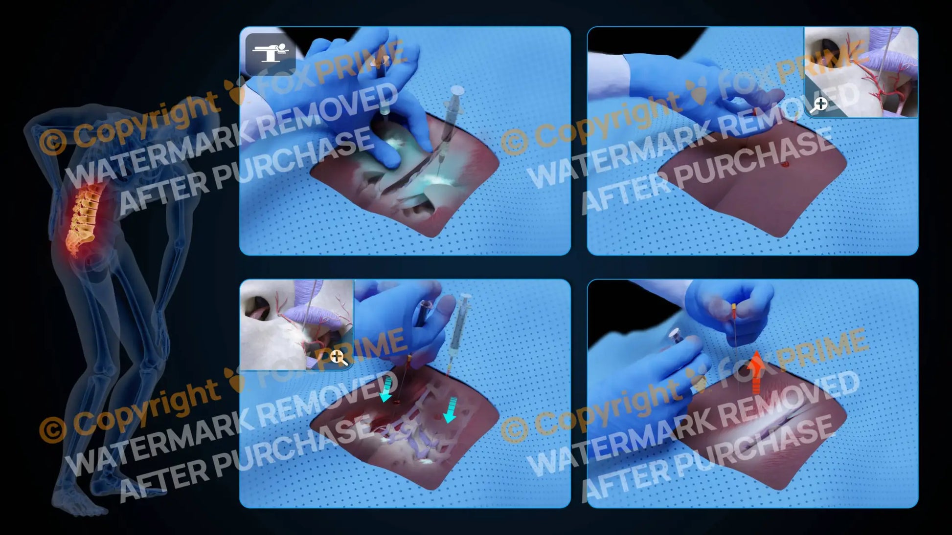 Bilateral Medial Branch Block L4-L5 (No Text) Still Shot