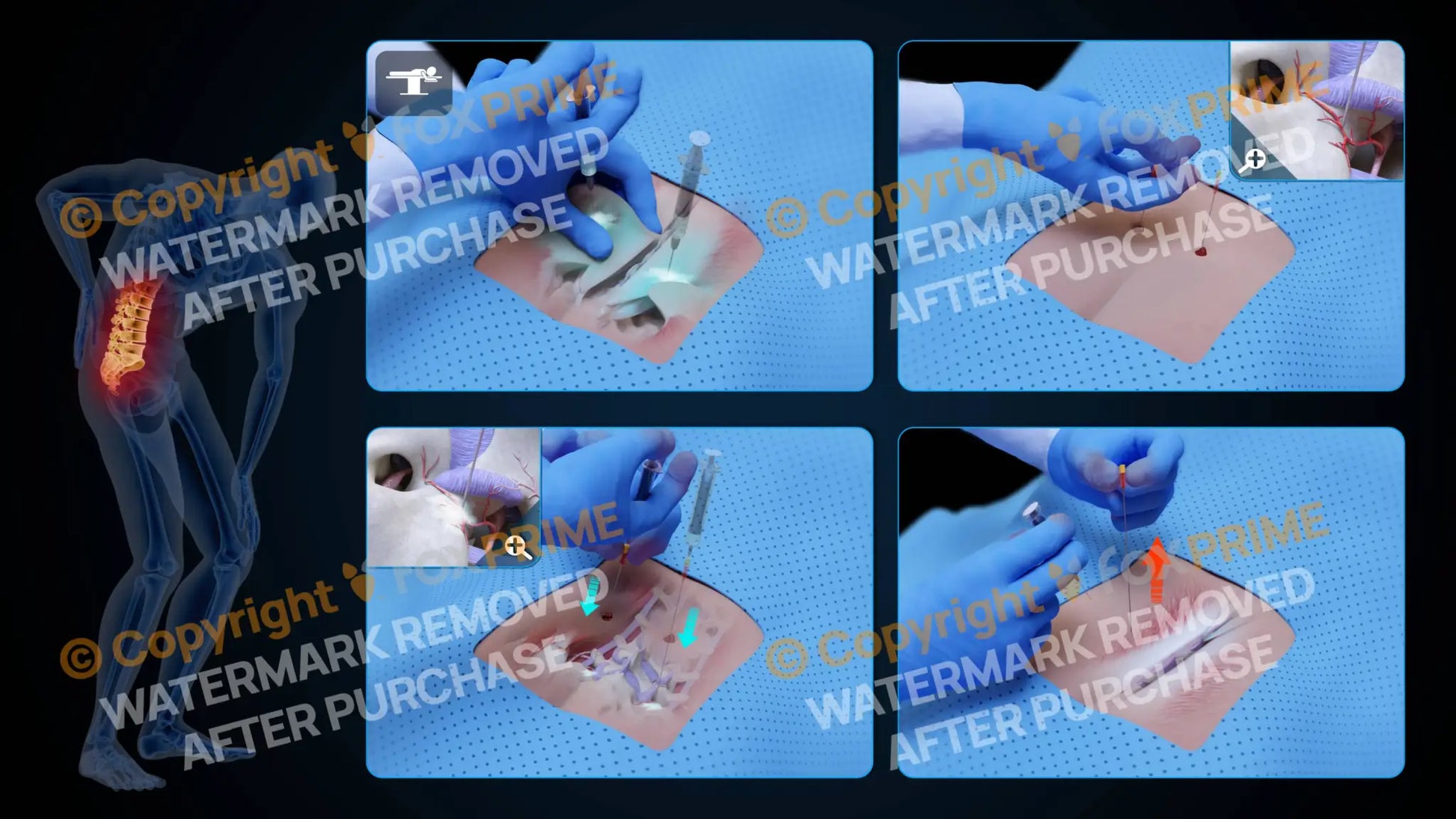 Bilateral Medial Branch Block L4-L5 (No Text) - Still Shot