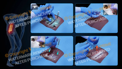 Bilateral Medial Branch Block L4-L5 (No Text) - Still Shot