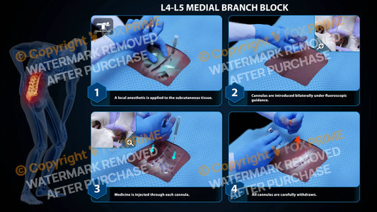Bilateral Medial Branch Block L4-L5 Still Shot