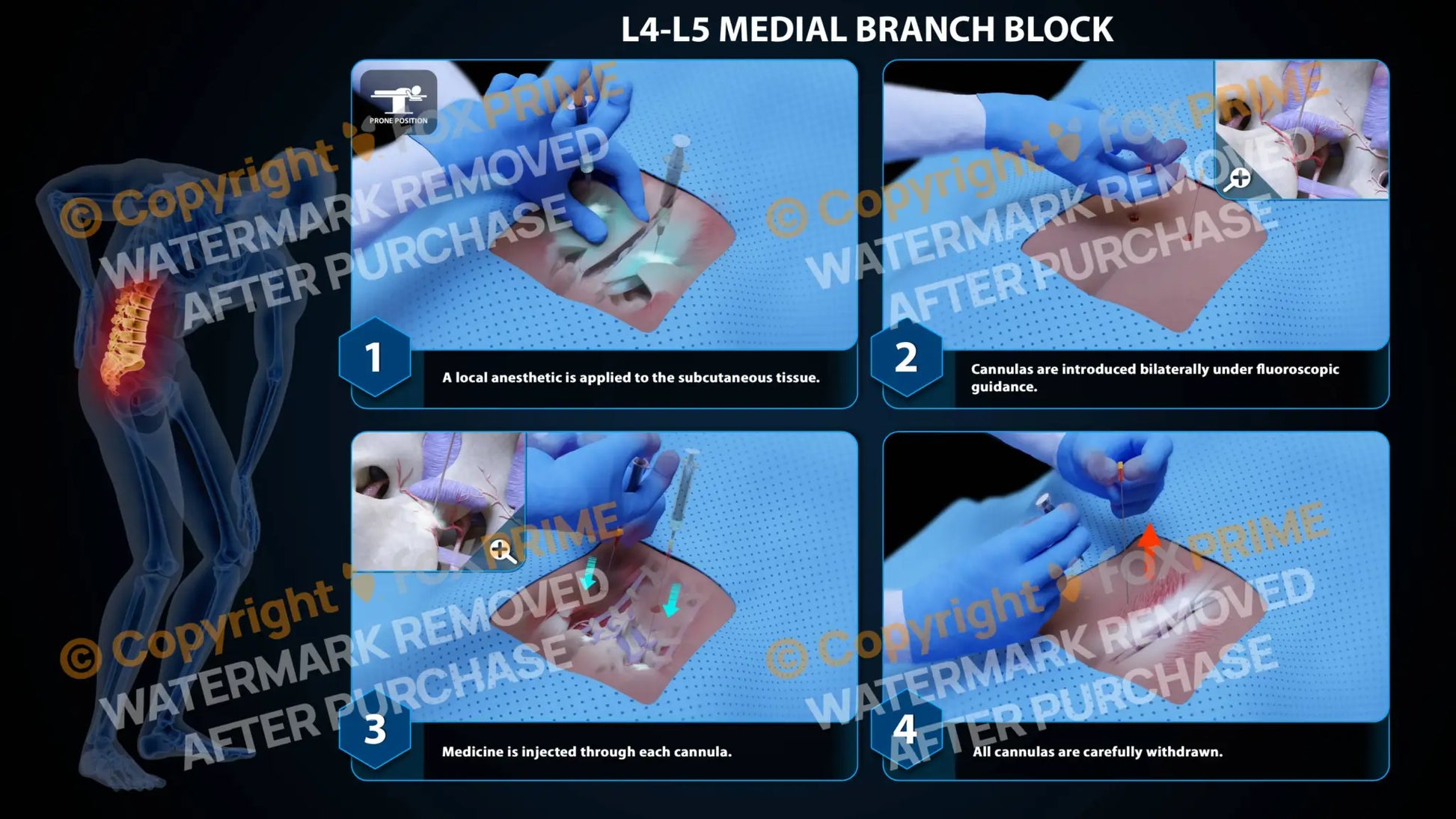 Bilateral Medial Branch Block L4-L5 Still Shot