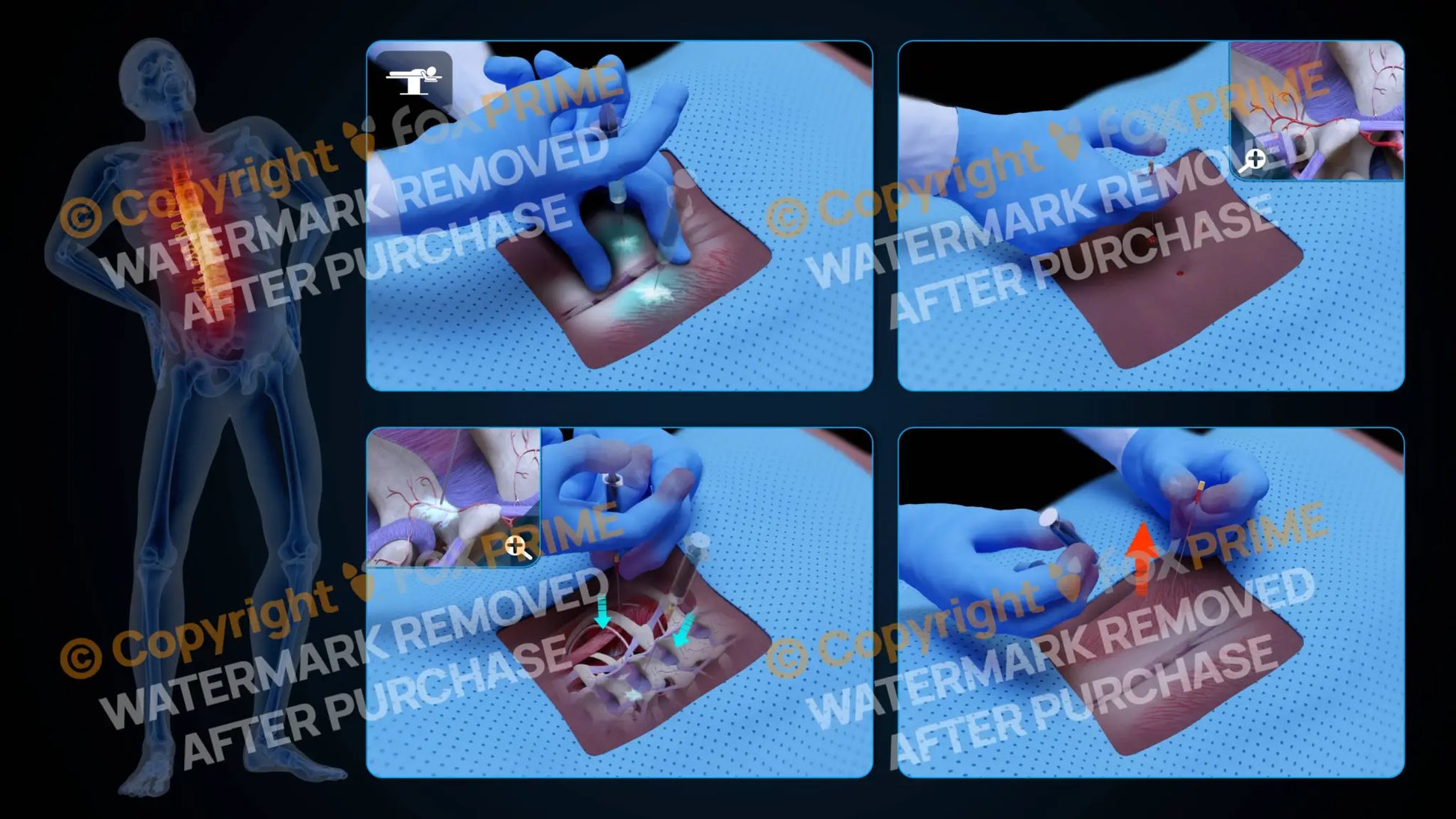Bilateral Medial Branch Block T11-T12 (No Text) - Still Shot