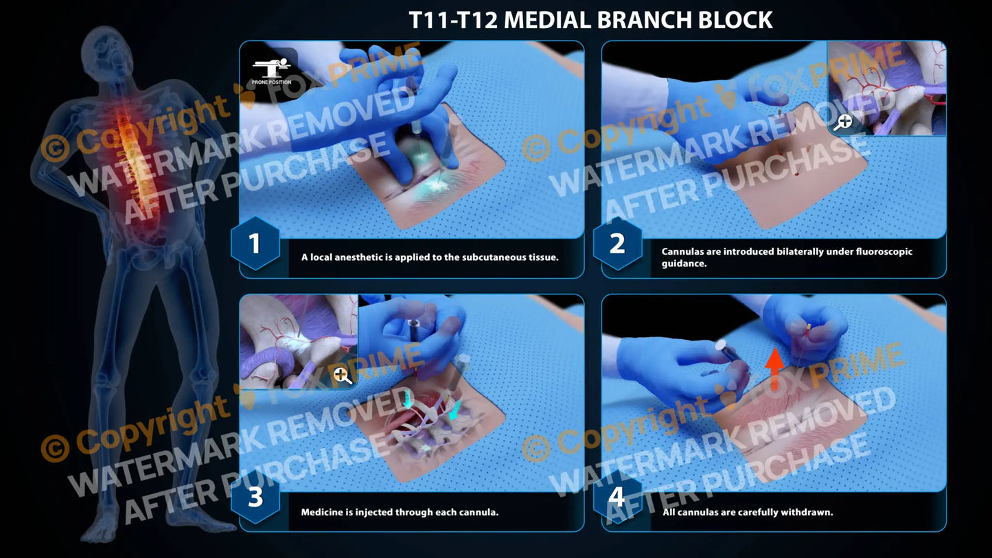 Bilateral Medial Branch Block T11-T12 (PowerPoint) - PowerPoint