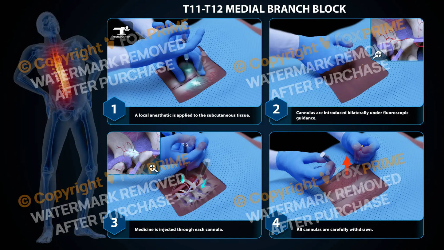 Bilateral Medial Branch Block T11-T12 - Still Shot