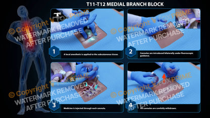 Bilateral Medial Branch Block T11-T12 Still Shot