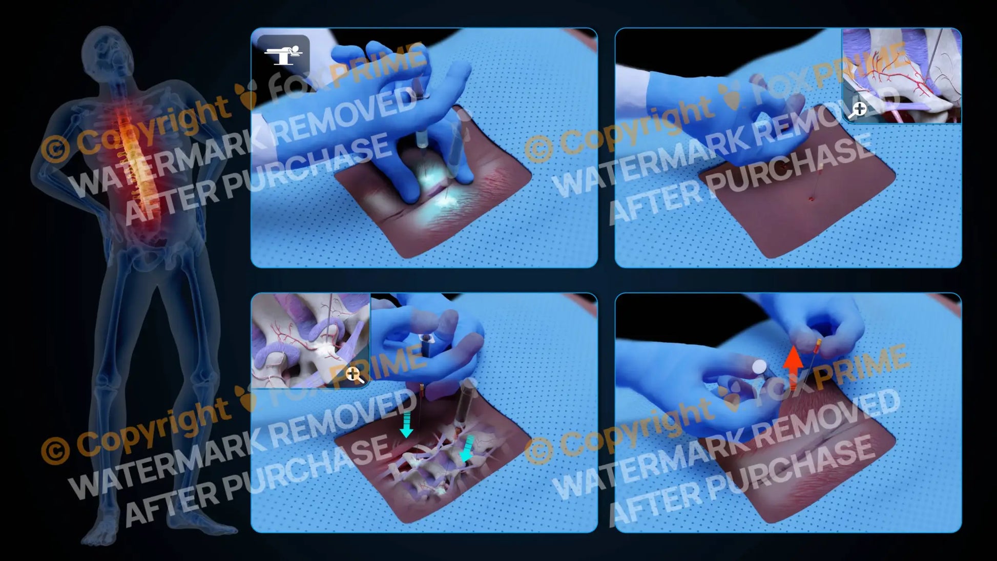 Bilateral Medial Branch Block T12-L1 (No Text) - Still Shot