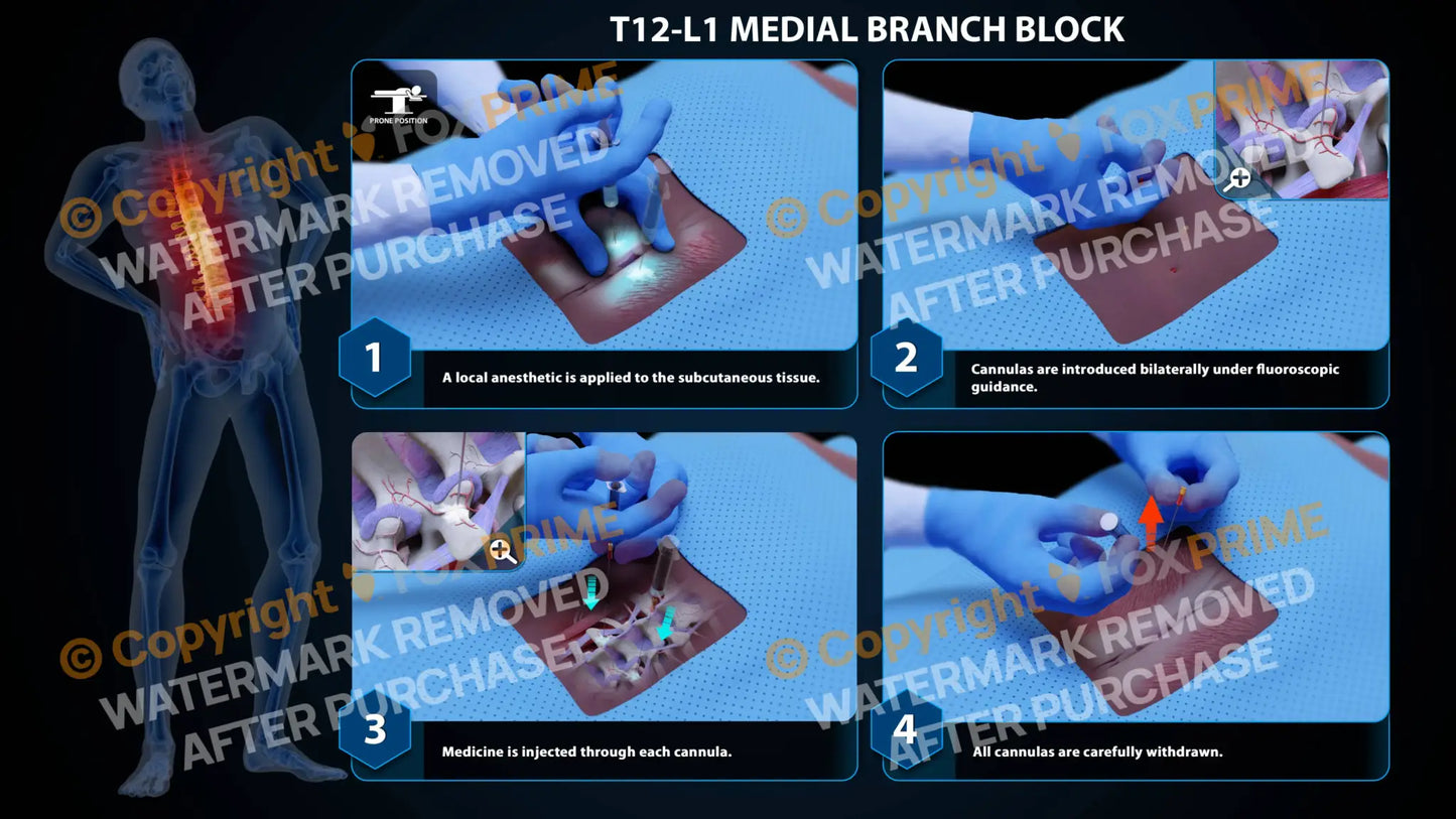 Bilateral Medial Branch Block T12-L1 (PowerPoint) - PowerPoint