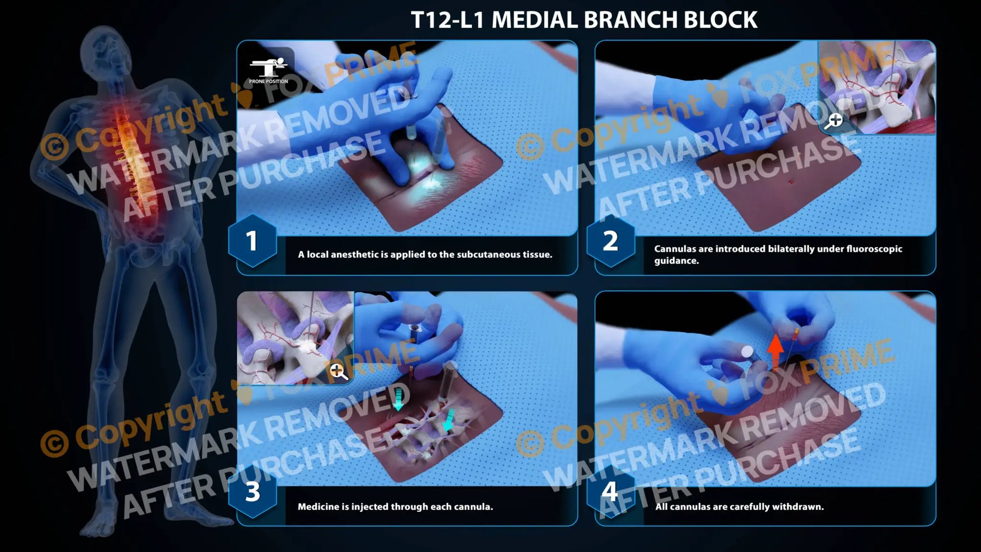 Bilateral Medial Branch Block T12-L1 (PowerPoint) - PowerPoint