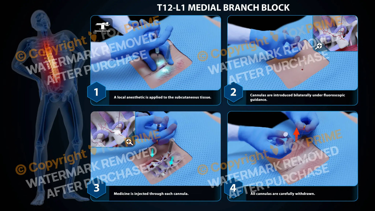 Bilateral Medial Branch Block T12-L1 (PowerPoint) - PowerPoint