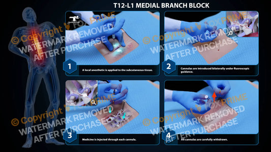 Bilateral Medial Branch Block T12-L1 (PowerPoint) - PowerPoint