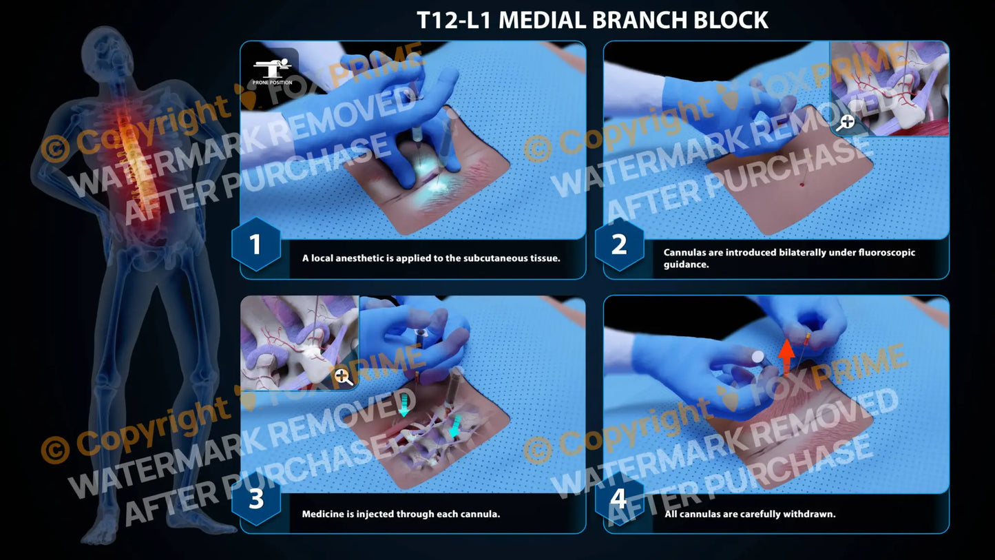 Bilateral Medial Branch Block T12-L1 - Still Shot