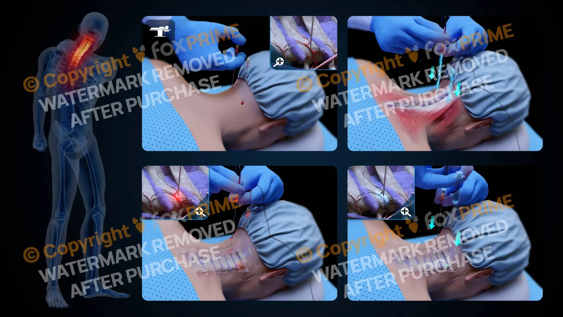 Bilateral Radiofrequency Ablation C2-C3 (No Text) Still Shot