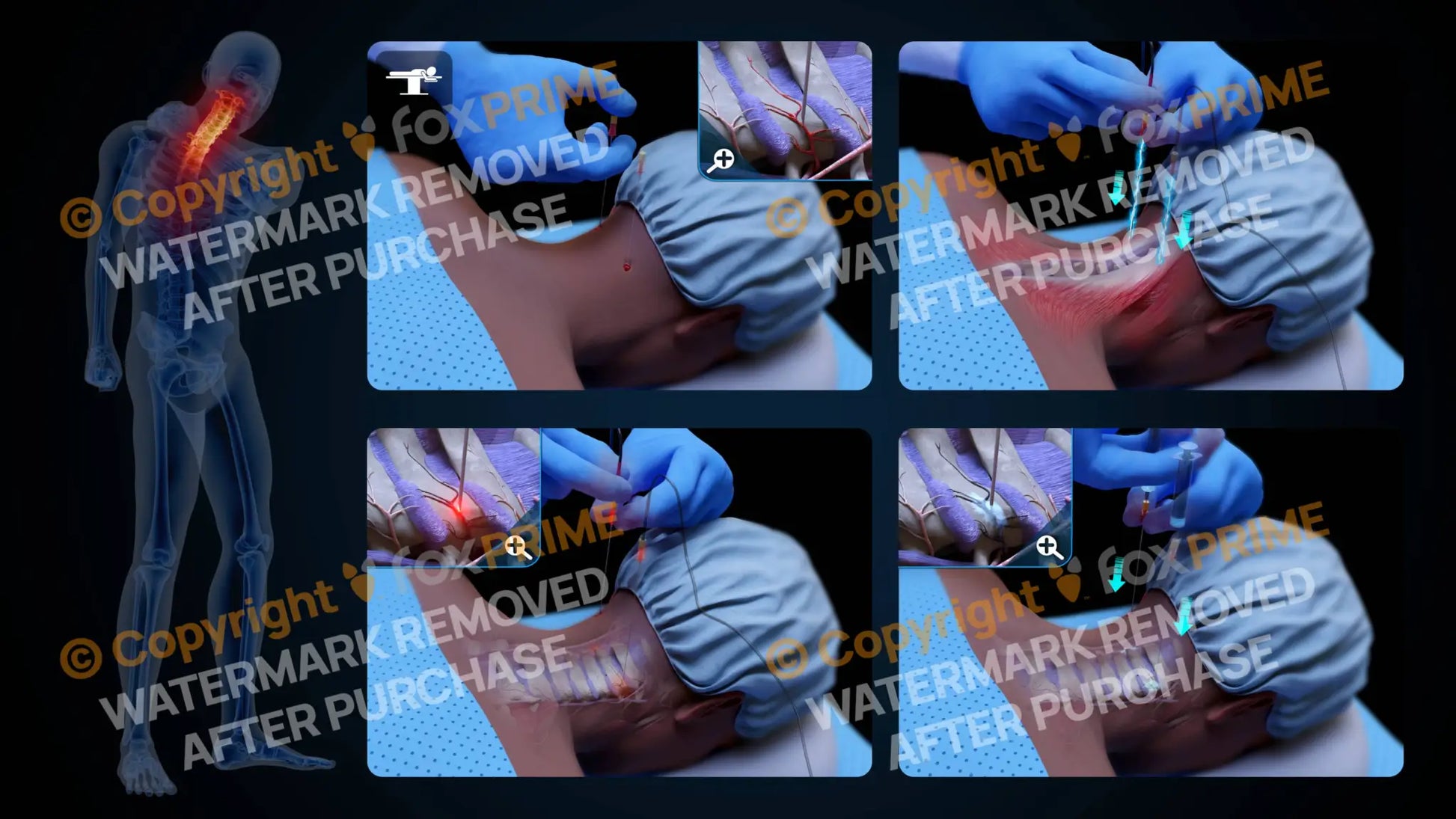 Bilateral Radiofrequency Ablation C2-C3 (No Text) - Still Shot