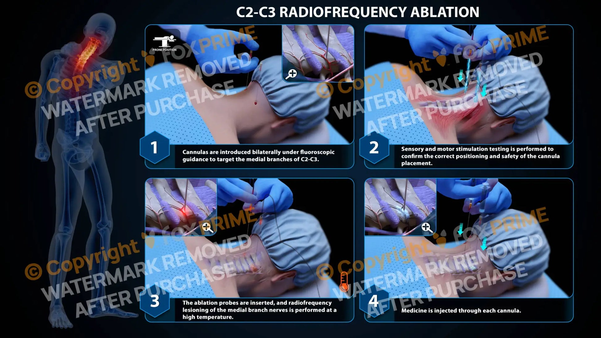 Bilateral Radiofrequency Ablation C2-C3 Still Shot