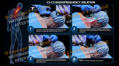 Bilateral Radiofrequency Ablation C2-C3 Still Shot