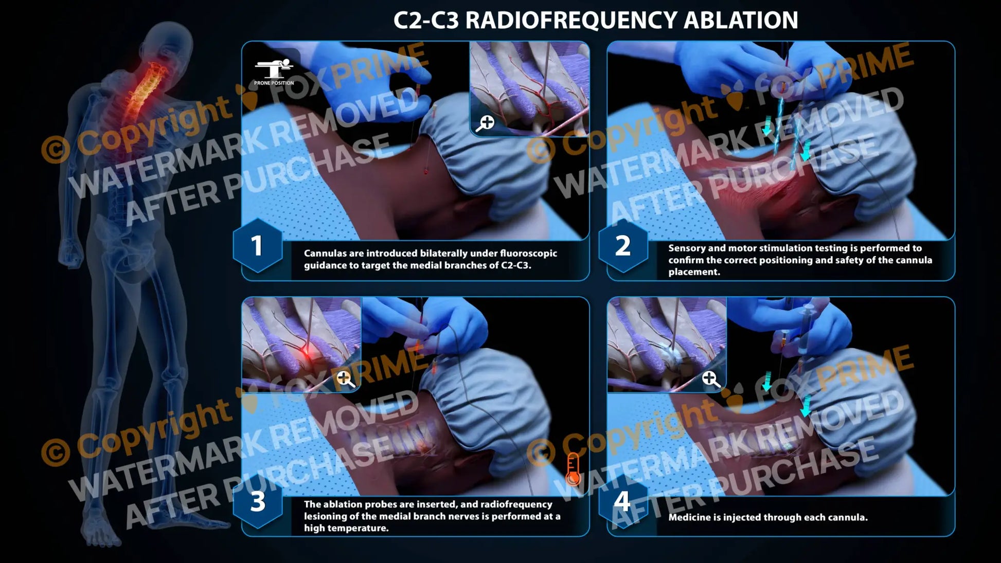 Bilateral Radiofrequency Ablation C2-C3 - Still Shot