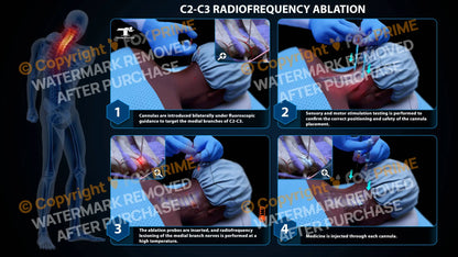 Bilateral Radiofrequency Ablation C2-C3 - Still Shot