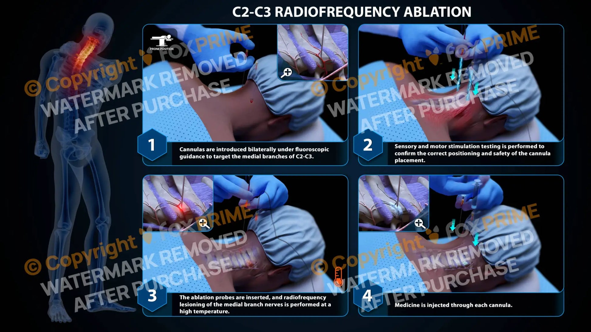 Bilateral Radiofrequency Ablation C2-C3 Still Shot