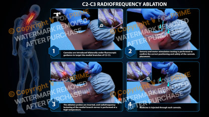 Bilateral Radiofrequency Ablation C2-C3 Still Shot