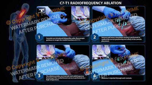 Bilateral Radiofrequency Ablation C7-T1 (PowerPoint) - PowerPoint