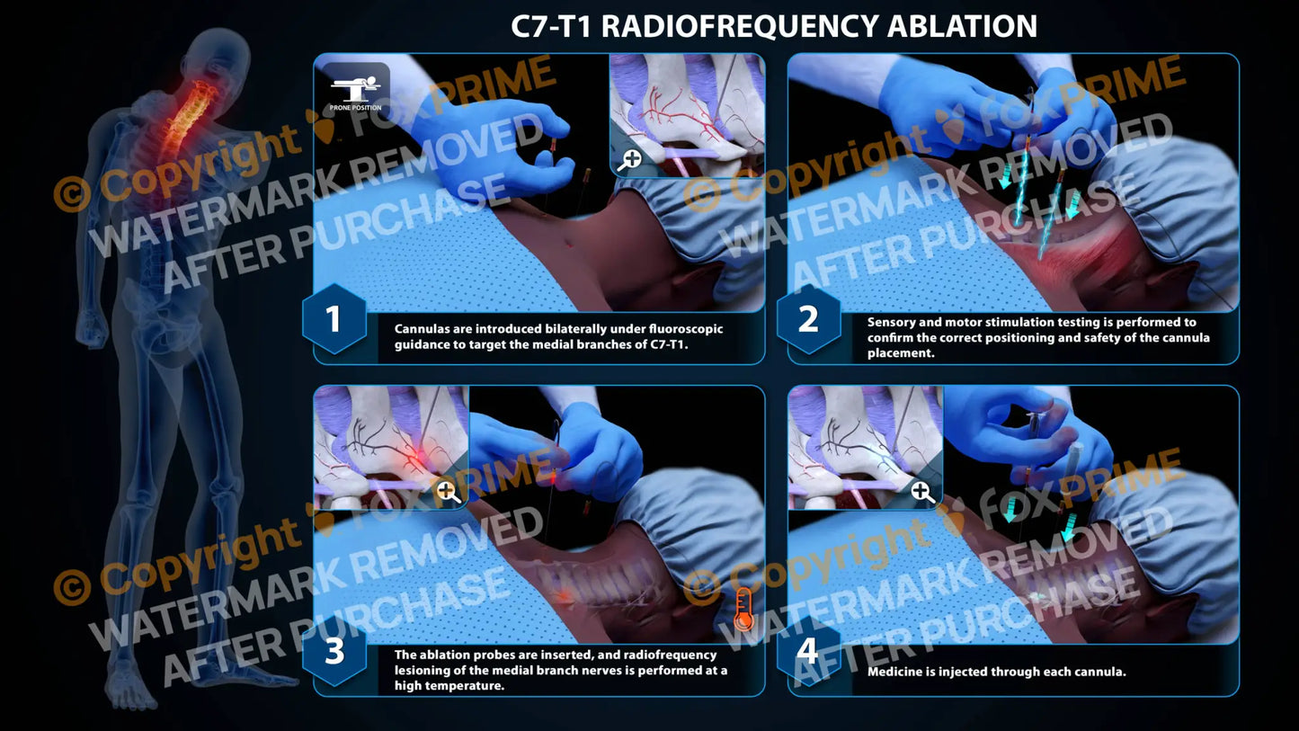 Bilateral Radiofrequency Ablation C7-T1 Still Shot