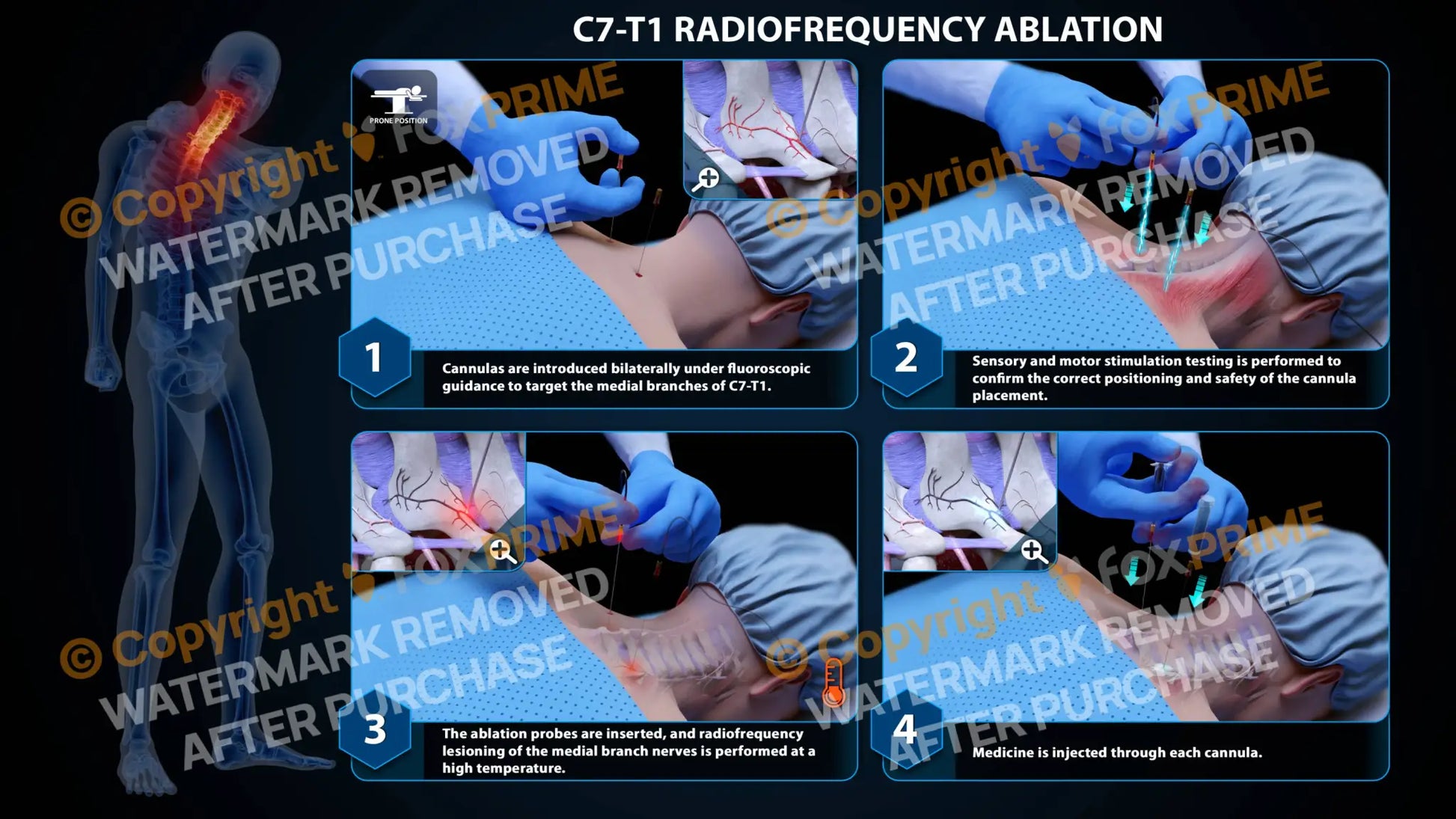 Bilateral Radiofrequency Ablation C7-T1 - Still Shot