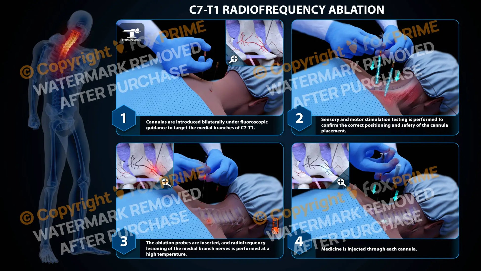 Bilateral Radiofrequency Ablation C7-T1 - Still Shot