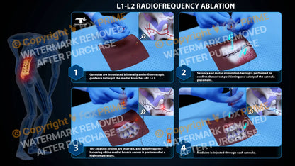 Bilateral Radiofrequency Ablation L1-L2 (PowerPoint) PowerPoint
