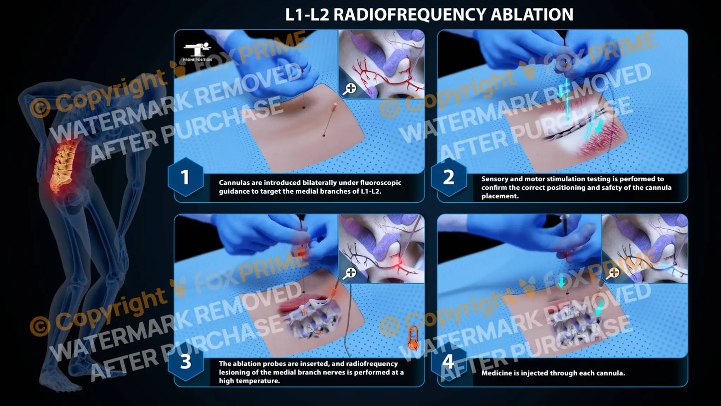 Bilateral Radiofrequency Ablation L1-L2 (PowerPoint) PowerPoint