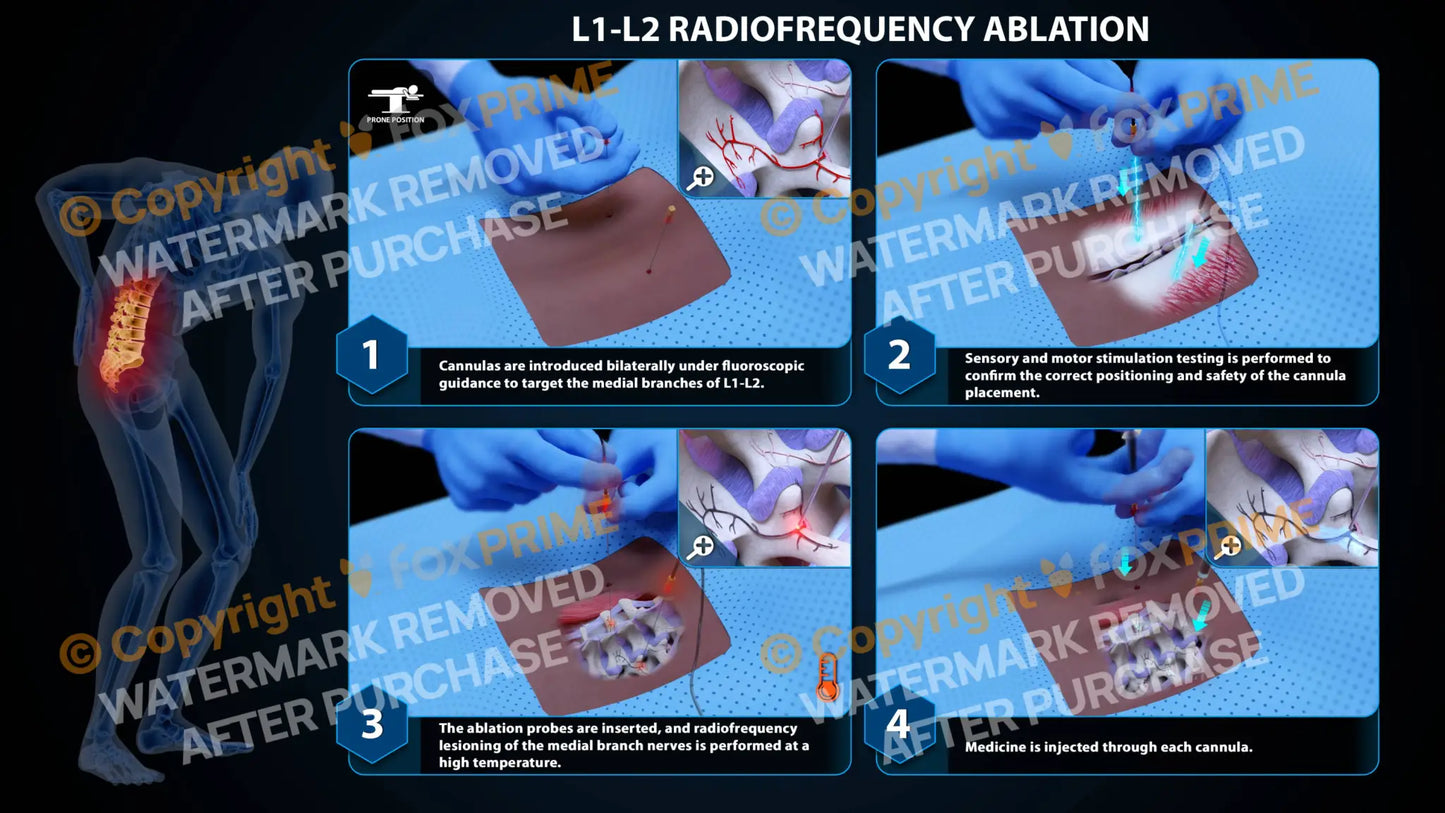 Bilateral Radiofrequency Ablation L1-L2 (PowerPoint) PowerPoint