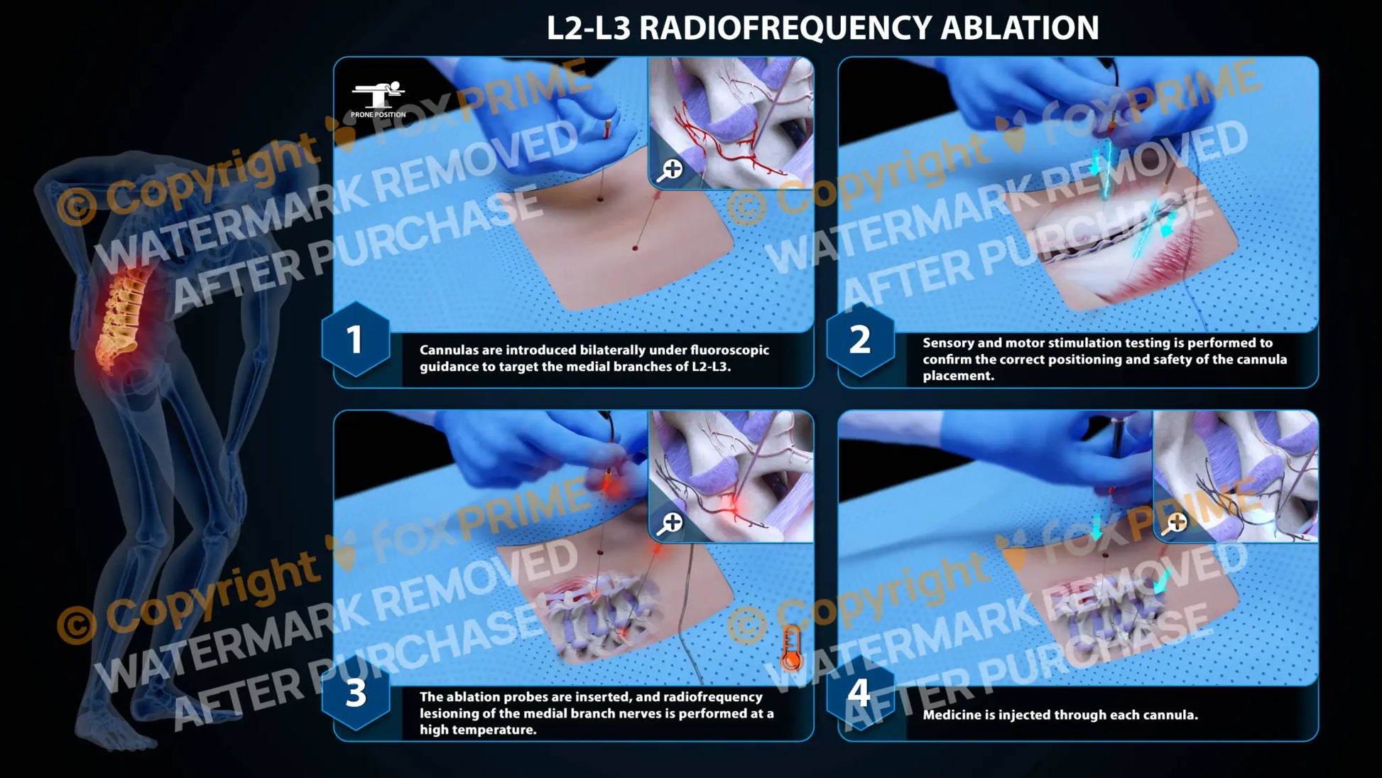 Bilateral Radiofrequency Ablation L2-L3 Still Shot