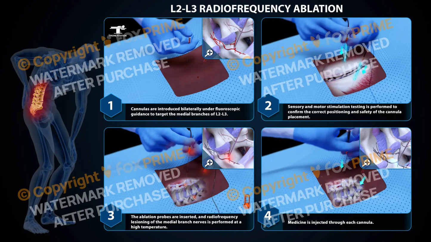 Bilateral Radiofrequency Ablation L2-L3 - Still Shot