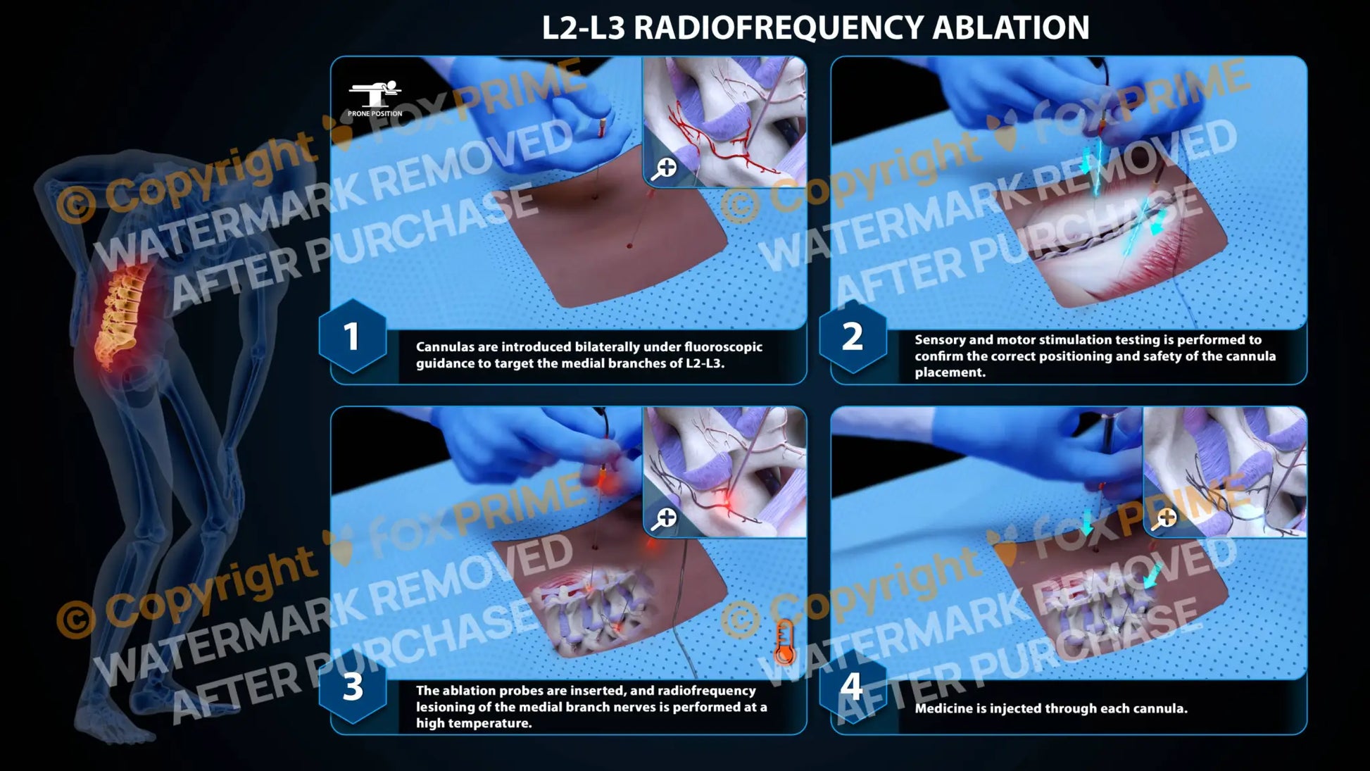 Bilateral Radiofrequency Ablation L2-L3 - Still Shot