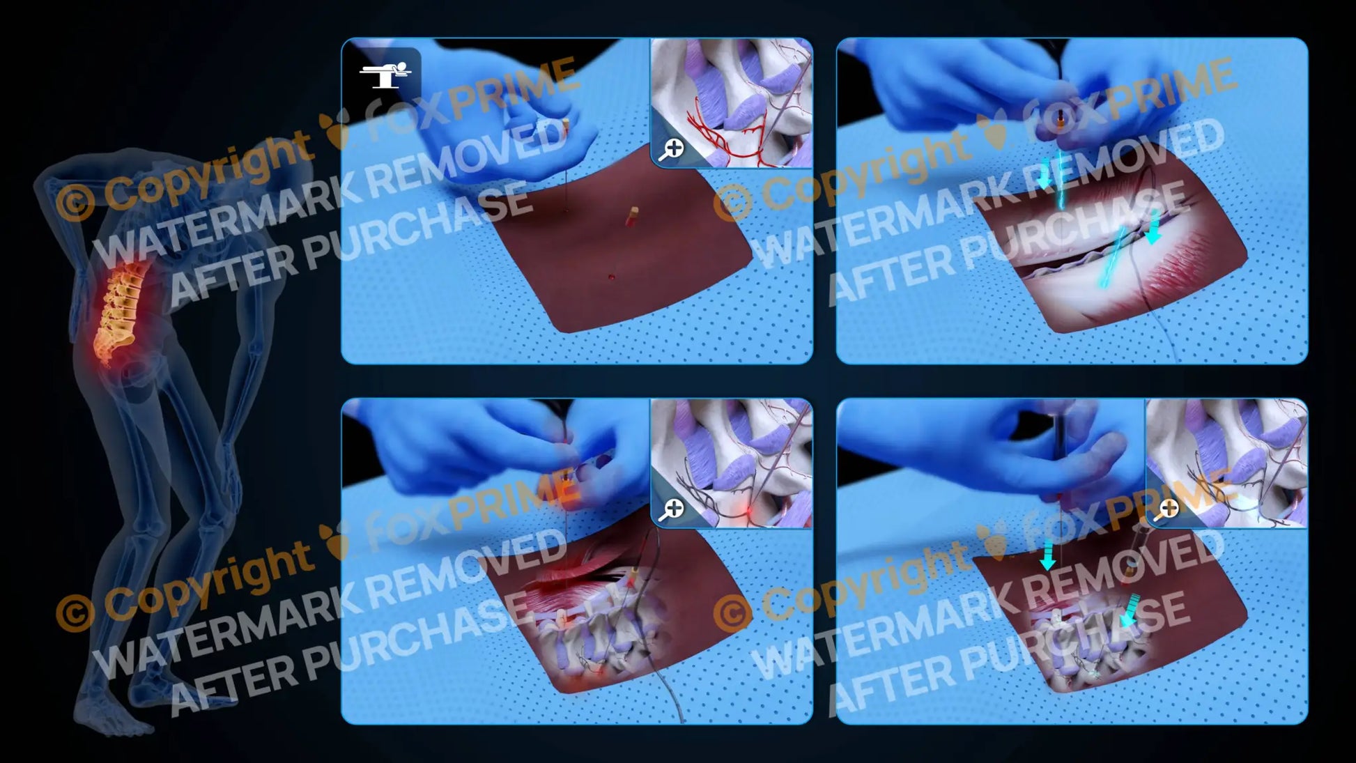 Bilateral Radiofrequency Ablation L3-L4 (No Text) - Still Shot